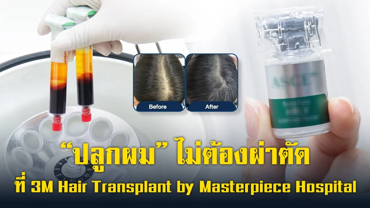 ปลูกผม แบบไม่ต้องผ่าตัด