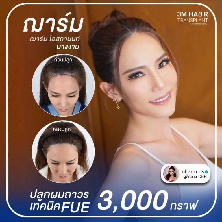 รีวิวปลูกผมคุณณาร์ม เทคนิคปลูก FUE