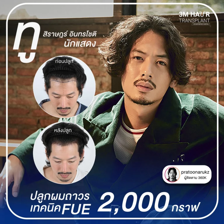 รีวิวปลูกผมคุณทู เทคนิคปลูก FUE