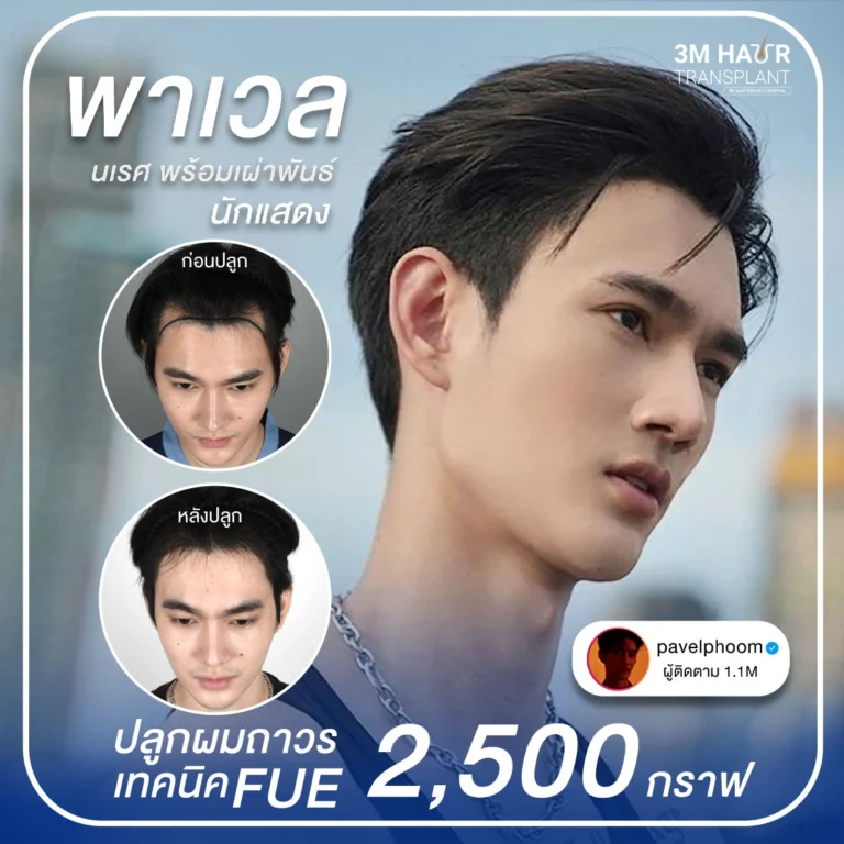 รีวิวปลูกผมคุณพาเวล เทคนิคปลูกผม FUE
