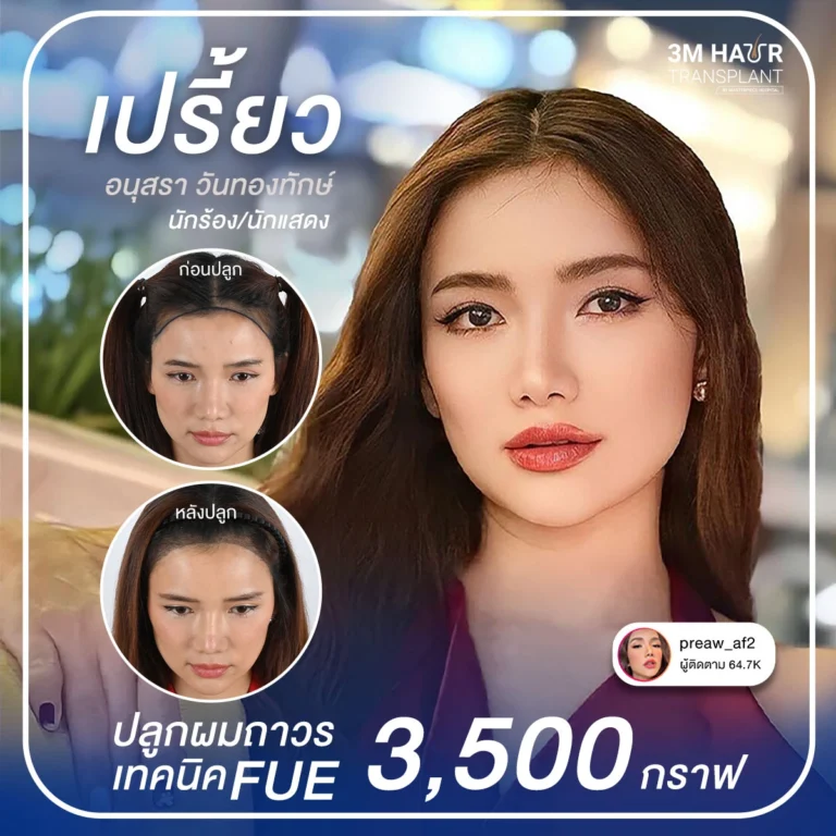 รีวิวปลูกผมคุณเปรี้ยว เทคนิค FUE