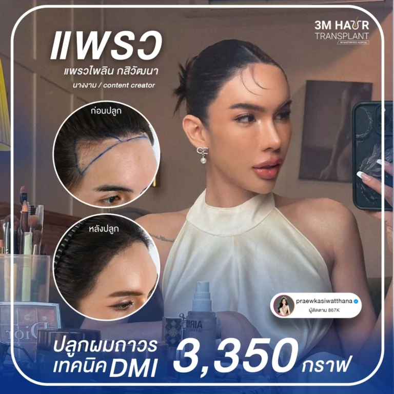 รีวิวปลูกผมคุณแพรว เทคนิคปลูกผม FUE