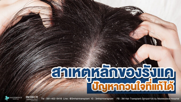 สาเหตุหลักของรังแค ปัญหากวนใจที่แก้ได้