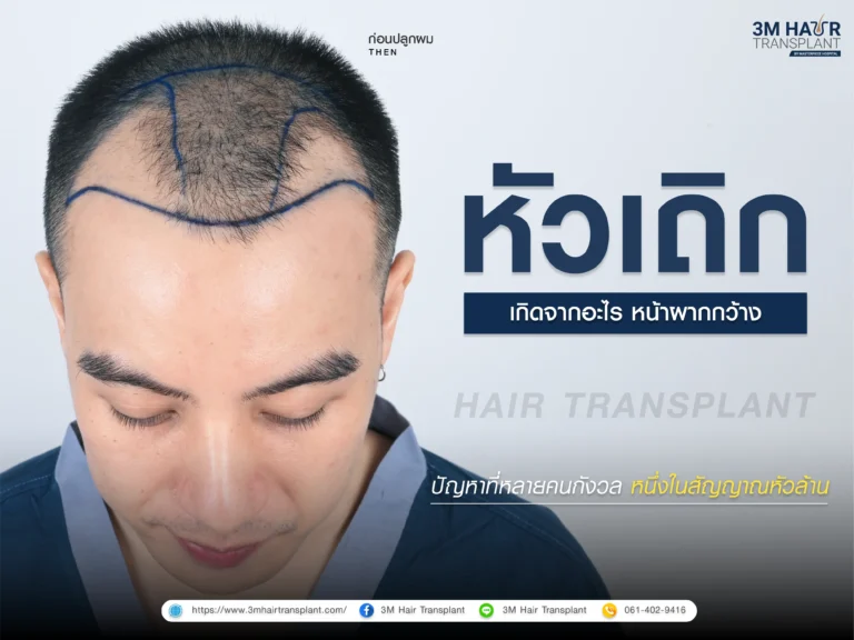 หัวเถิก เกิดจากอะไร หน้าผากกว้าง แก้ไขได้ไหม