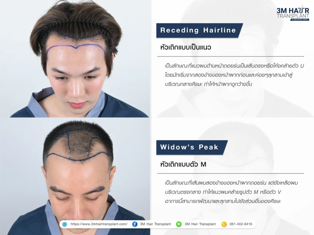 หัวเถิกมีลักษณะอย่างไร แบบใดบ้าง