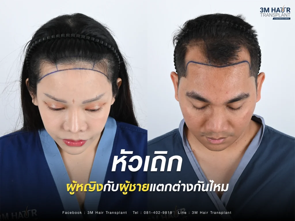 หัวเถิกของผู้หญิงกับผู้ชายมีความแตกต่างกันไหม