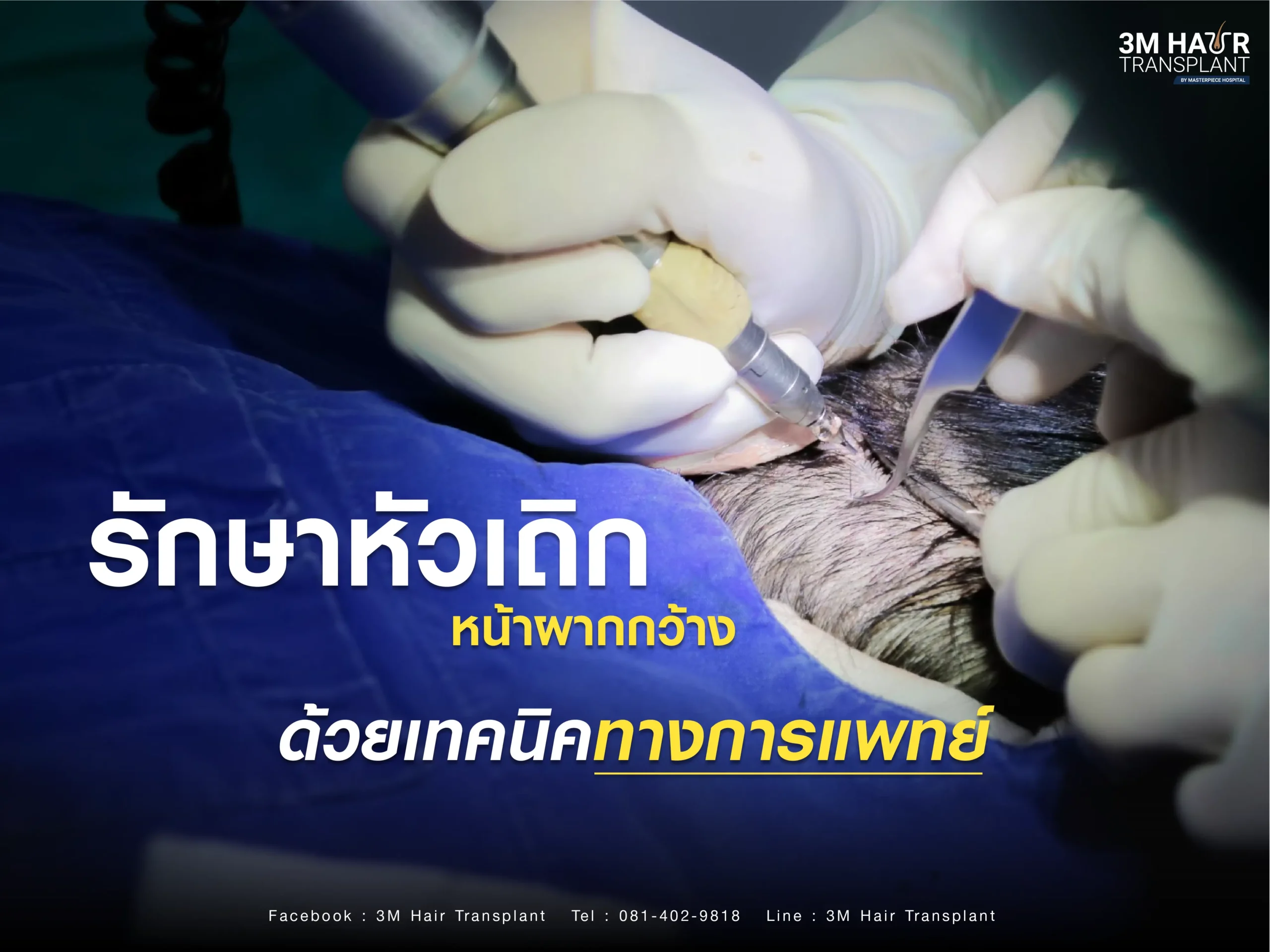 วิธีการรักษาหัวเถิก หน้าผากกว้าง ด้วยเทคนิคทางการแพทย์
