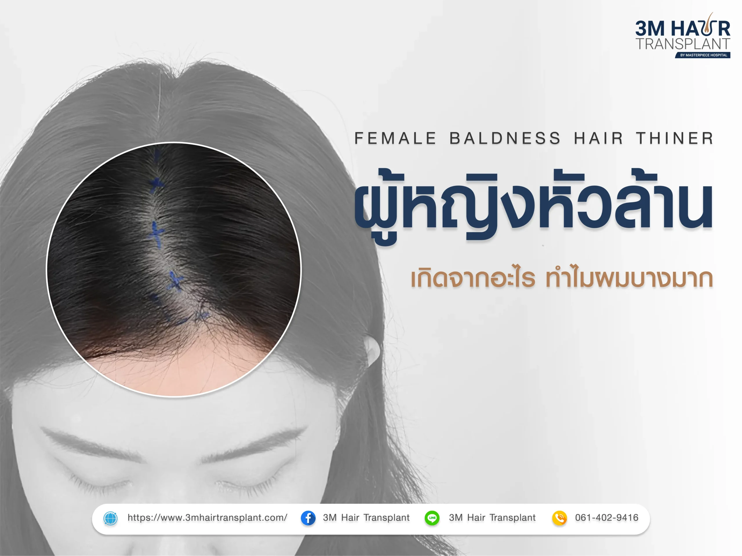 ผู้หญิงหัวล้าน ผมบางมาก เกิดจากอะไร ทำไมถึงผมถึงบางมาก ?