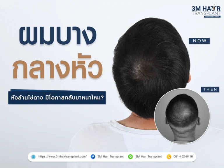 ผมบางกลางหัว หัวล้านไข่ดาว มีโอกาสกลับมาหนาได้ไหม ?
