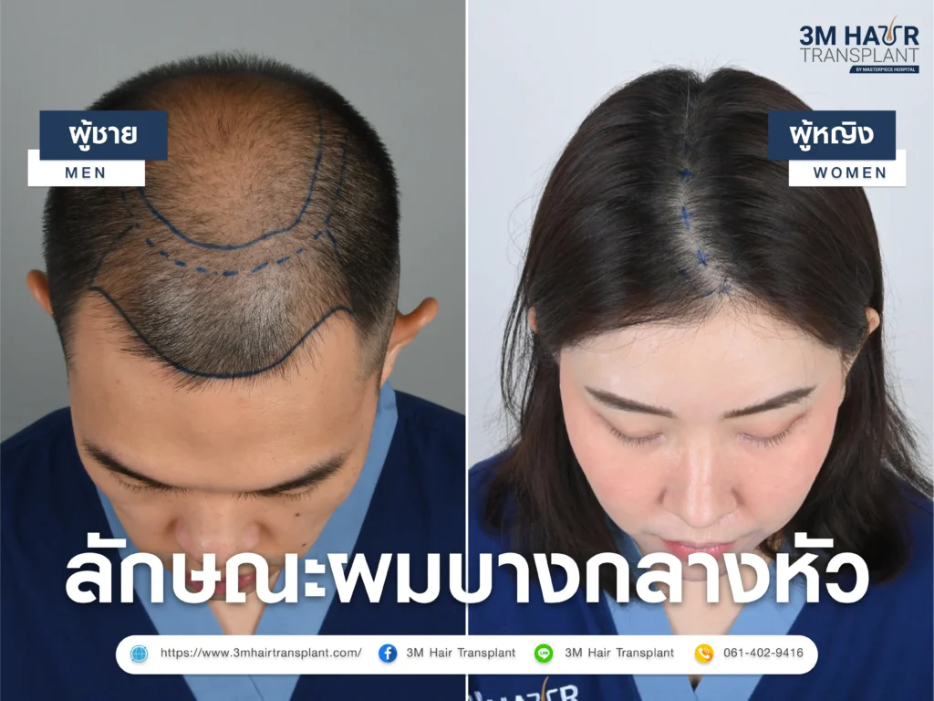 ลักษณะของผมบางกลางหัวที่พบบ่อย
