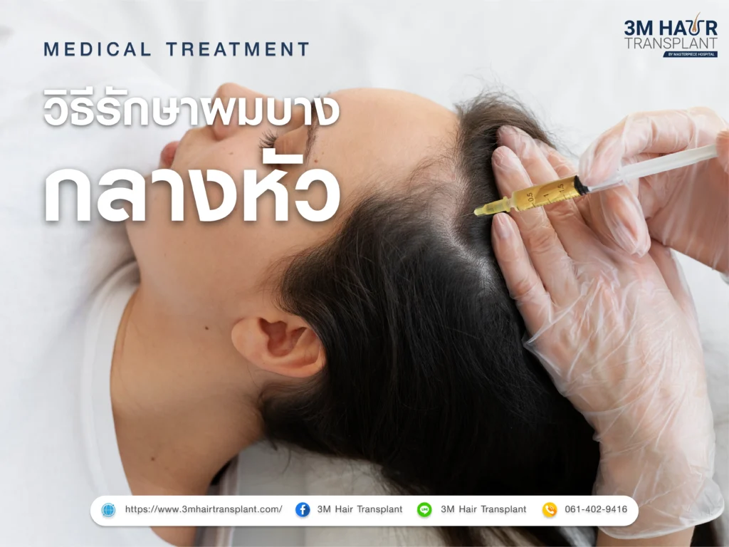วิธีรักษาผมบางกลางหัว Medical Treatments