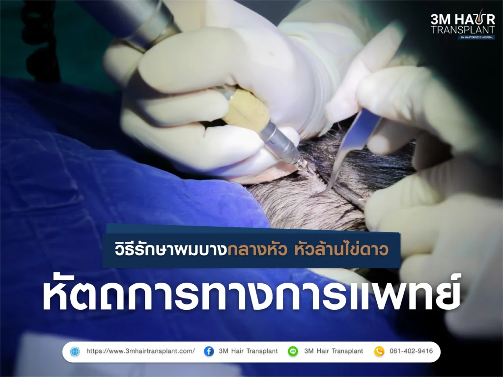 วิธีรักษาผมบางกลางหัว หัวล้านไข่ดาว หัตถการทางการแพทย์