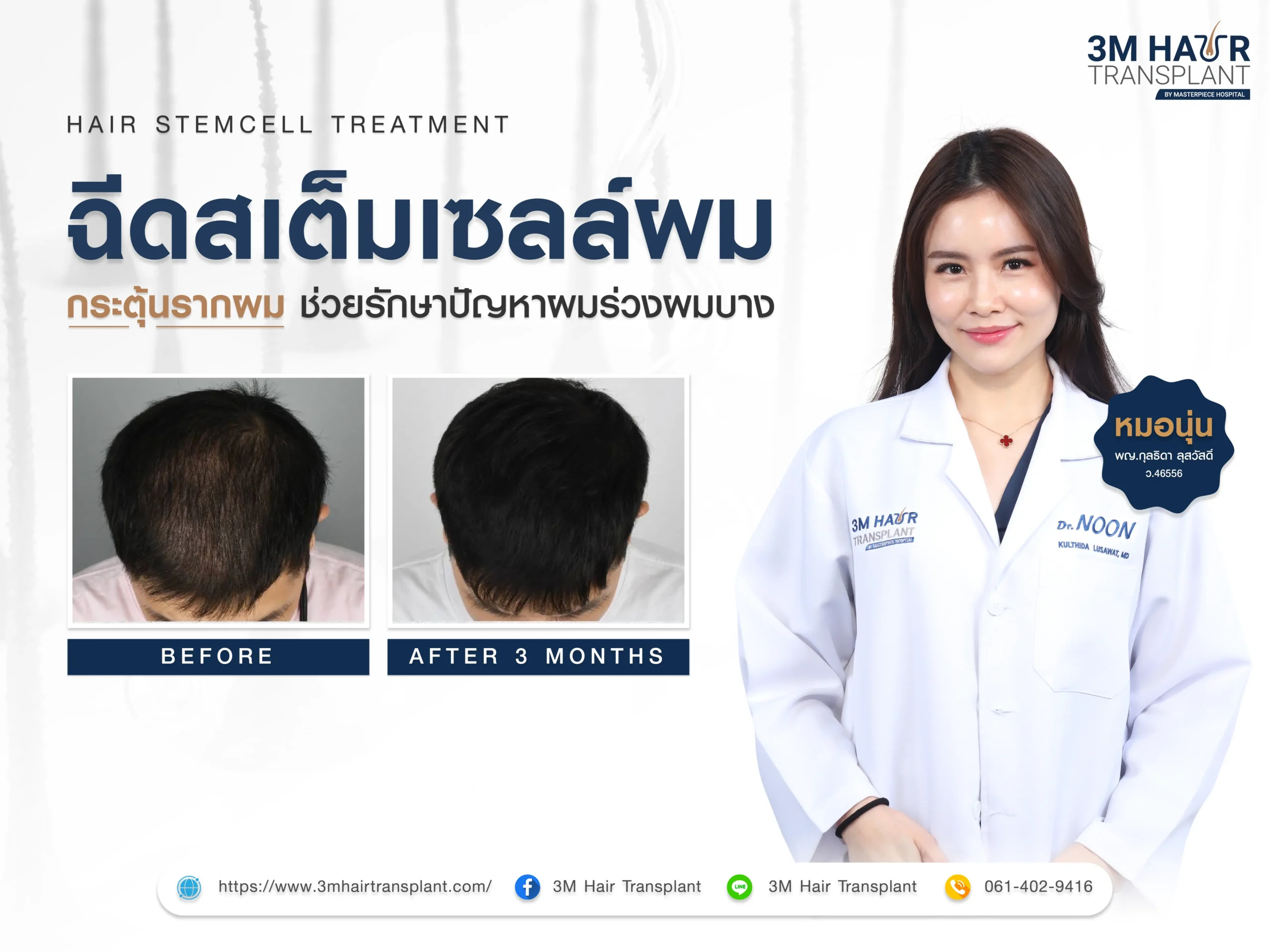 ฉีดสเต็มเซลล์ผม กระตุ้นรากผม ช่วยรักษาปัญหาผมร่วงผมบาง?
