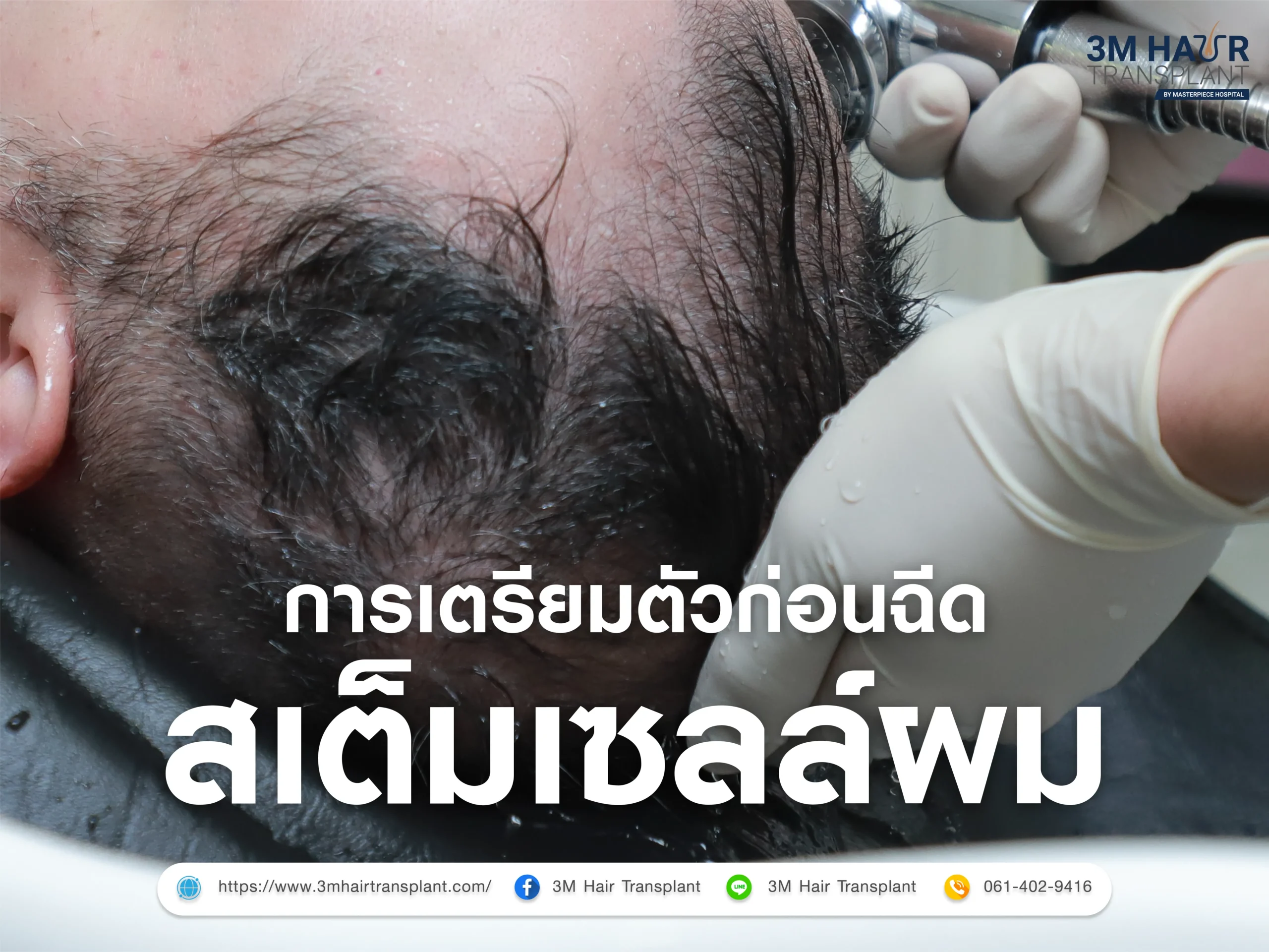 การเตรียมตัวก่อนการ ฉีดสเต็มเซลล์ผม