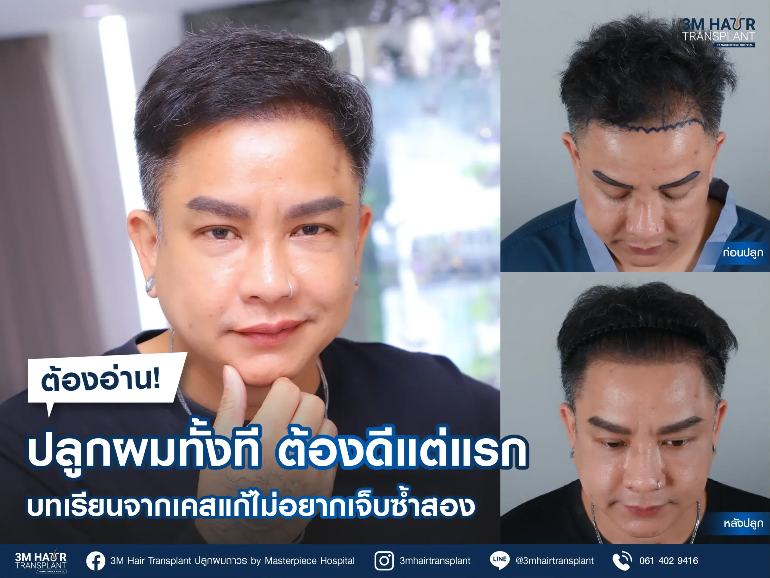 ถอดรหัส "เคสแก้" ทำไมใครๆ ก็เลือกมาซ่อมที่ 3M Hairtransplant Masterpiece Hospital