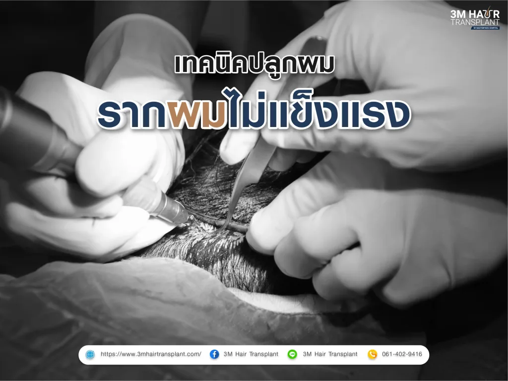ศัลยกรรมปลูกผม ช่วยเรื่องรากผมไม่แข็งแรง มีเทคนิคอะไรบ้าง