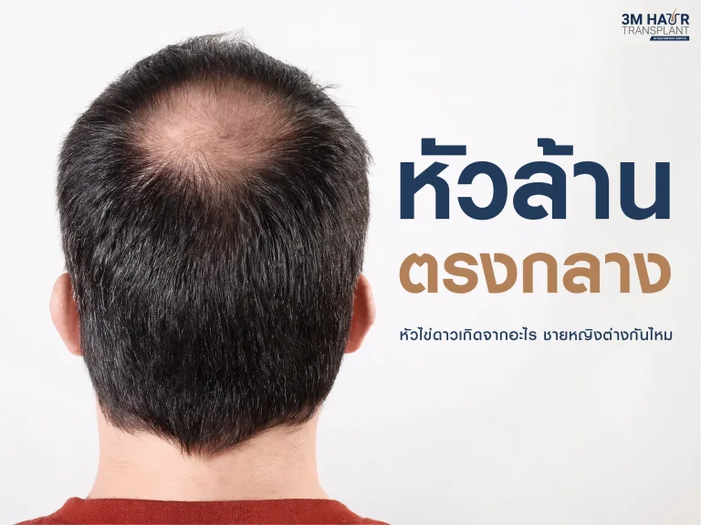 หัวล้านตรงกลาง หัวไข่ดาวเกิดจากอะไร ผู้หญิงผู้ชายต่างกันไหม