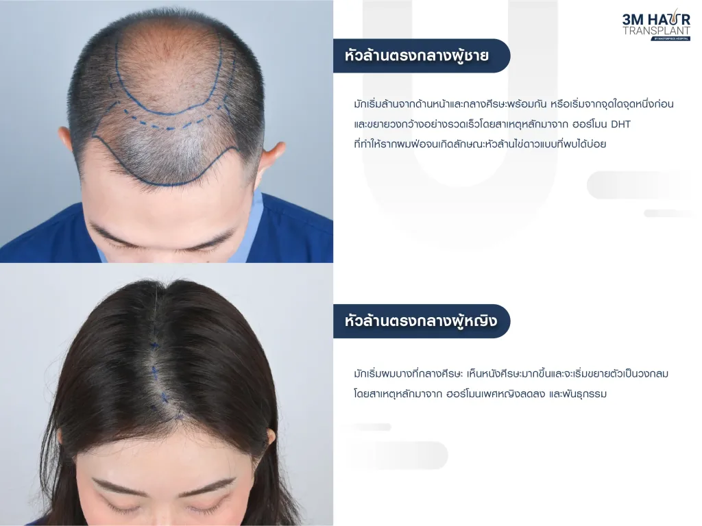 หัวล้านตรงกลางของผู้หญิงกับผู้ชายมีความแตกต่างกันไหม