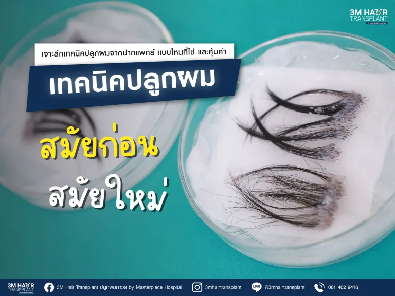 3M Hairtransplant เจาะลึกวิวัฒนาการปลูกผม จากเทคนิคสมัยก่อน สู่เทคนิคสมัยใหม่ โดย หมอพิ้งกี้